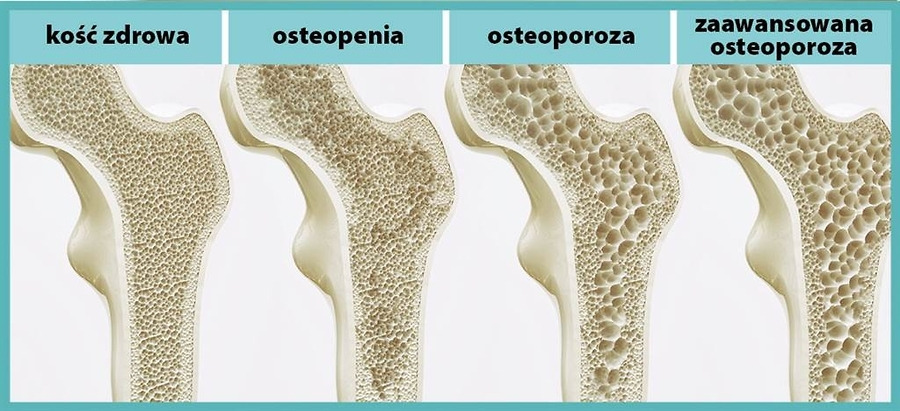 Que es osteopenia